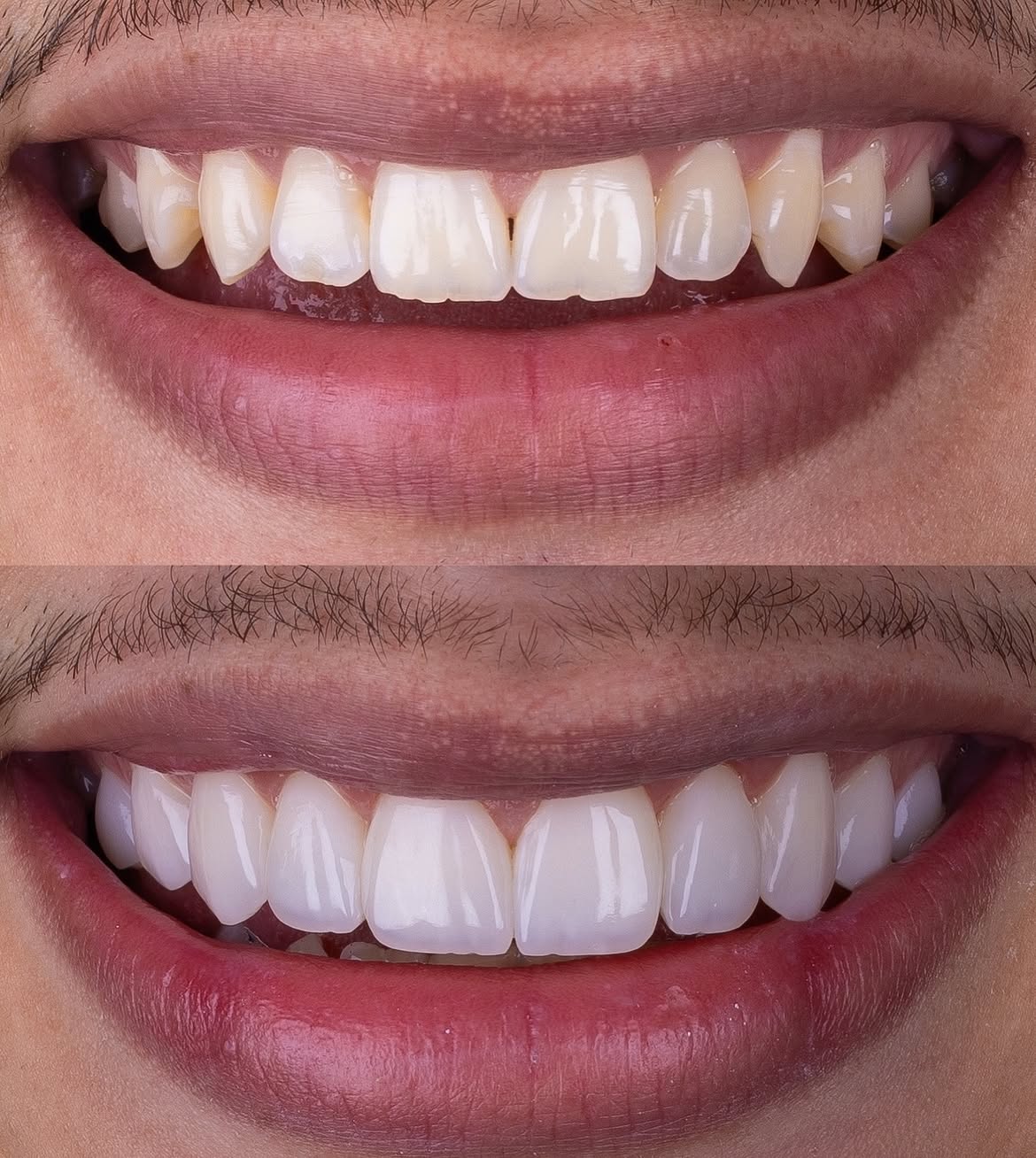 Antes e depois — caso 2