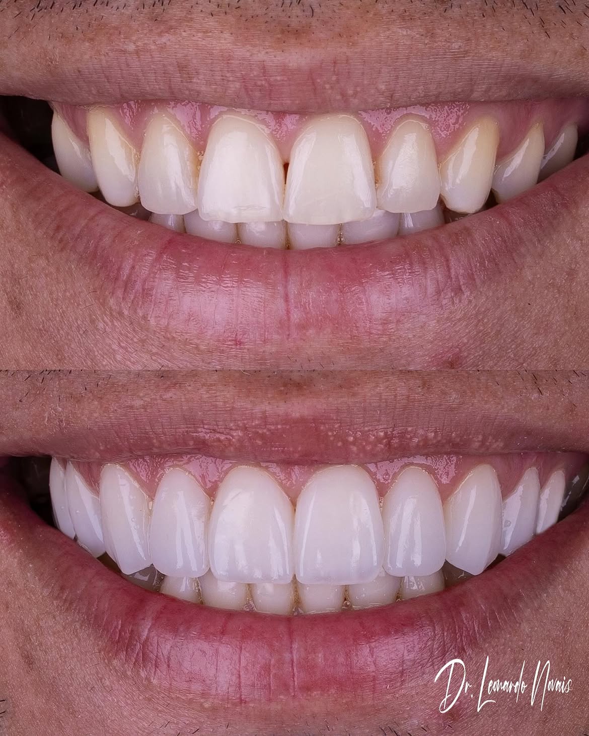 Antes e depois — caso 1